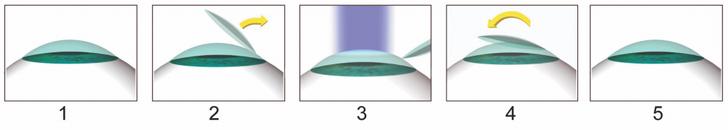 Steps of LASIK eye surgery procedure.