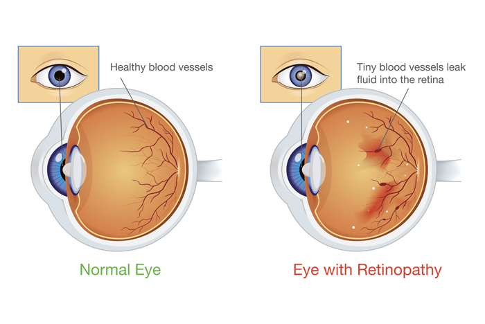 Anatomy of an eye with diabetic retinopathy