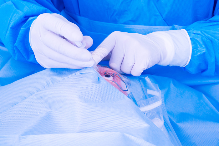 corneal transplant surgery