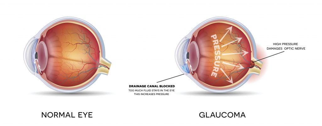 Anatomy of an eye with and without Glaucoma